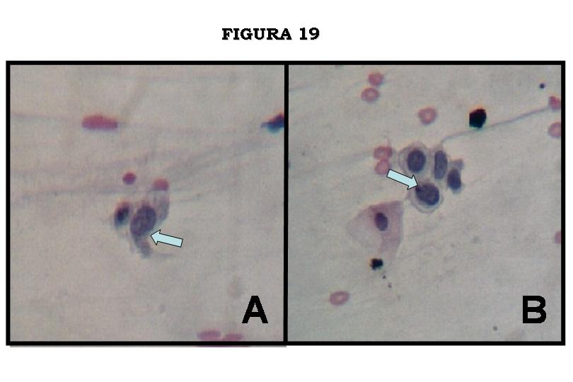 Figura 19. Fotomicrografias mostrando critrios citolgicos (setas) pr-malignos, de pleomorfismo, quebra da relao ncleo-citoplasma, clulas em girino, nuclolos proeminentes e irregularidades da membrana nuclear, associados a Leses intra-epiteliais escamosas de alto grau (HSIL), e observados pelos mtodos de Citologia Convencional (A e B). No tendo sido possvel, neste caso, sua demonstrao pelo mtodo de Citologia de Base Lquida.